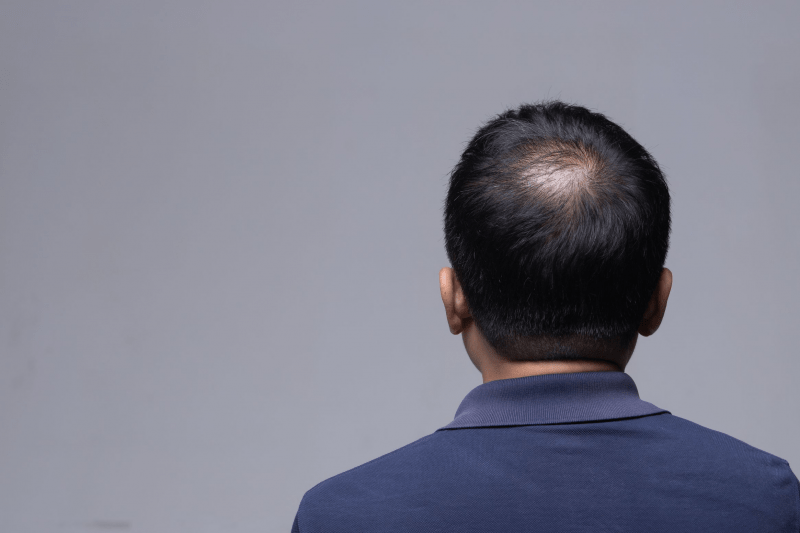 15 Ciri Rambut Rontok yang Disebabkan Oleh Penyakit Tertentu